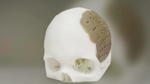 oxford-medicine-3D-printed-skull-implant